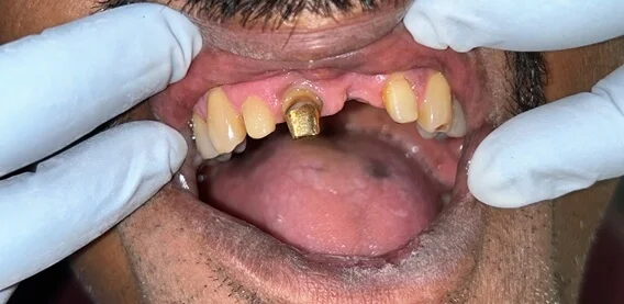 Prosthodontics Before