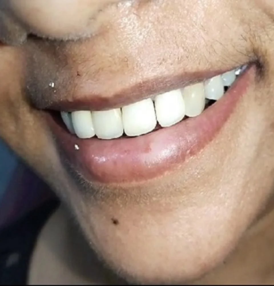 Dental Filling